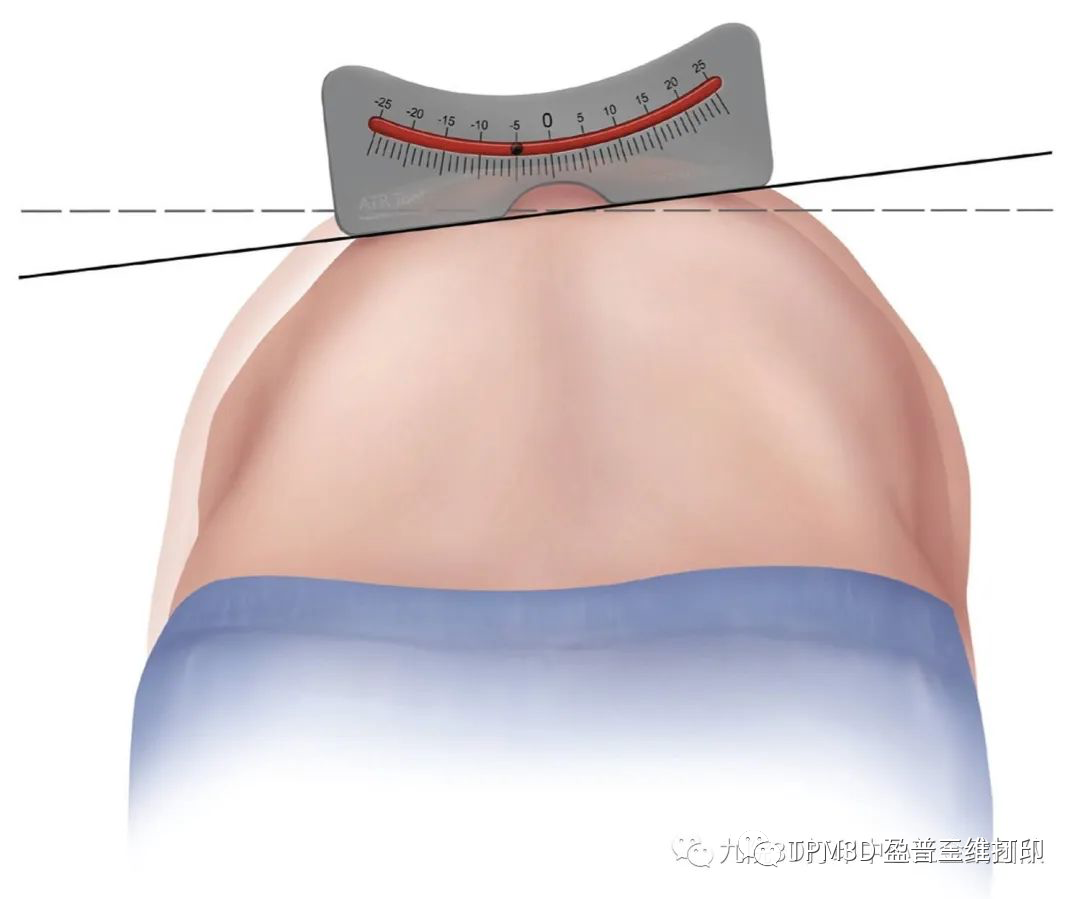 脊柱侧弯检测