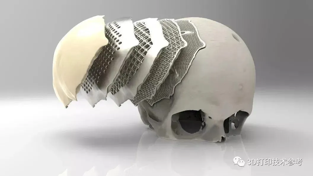 与金属植入物相比，PEEK具有三个突出优势