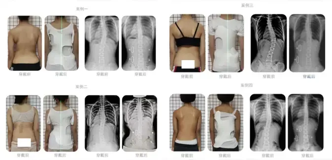 imgi 30 脊柱侧弯矫形效果