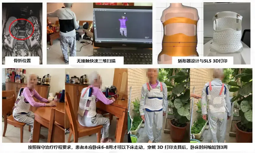 imgi 33 胸腰支具矫形效果