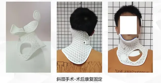 imgi 35 斜颈支具