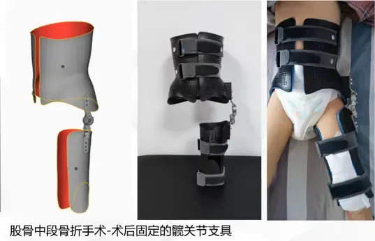 imgi 44 髋关节矫形器效果