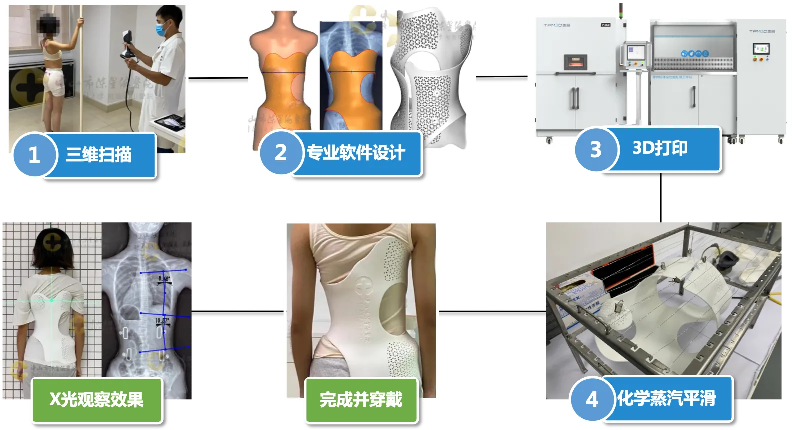 SLS 3D打印脊柱侧弯矫形器的制作流程