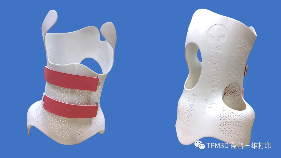 盈普三维SLS 3D打印脊柱侧弯矫形器技术再上榜
